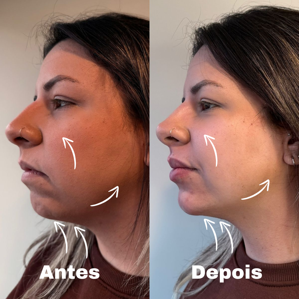 LiftContour-Escova De Drenagem Linfática e Contorno Facial