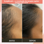 ScalpBrush-Escova Led Terapia Capilar 4 em 1 mais Óleo de Alecrim de BRINDE